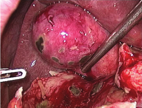 gangrenous gallbladder surgery