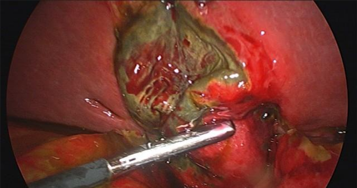 gangrenous gallbladder surgery dr tulip hospital surgery in Bangalore
