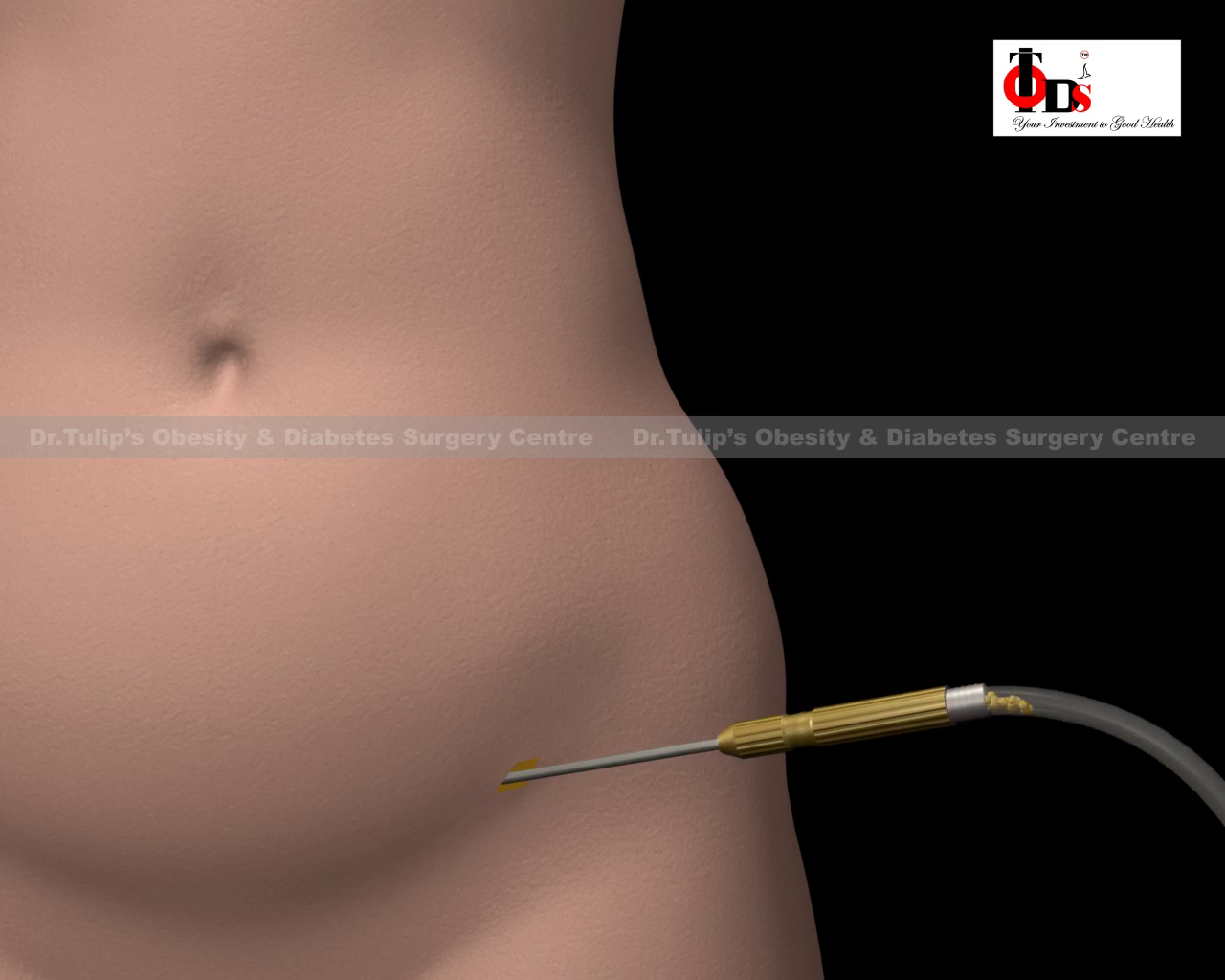  Haital Hernia surgery