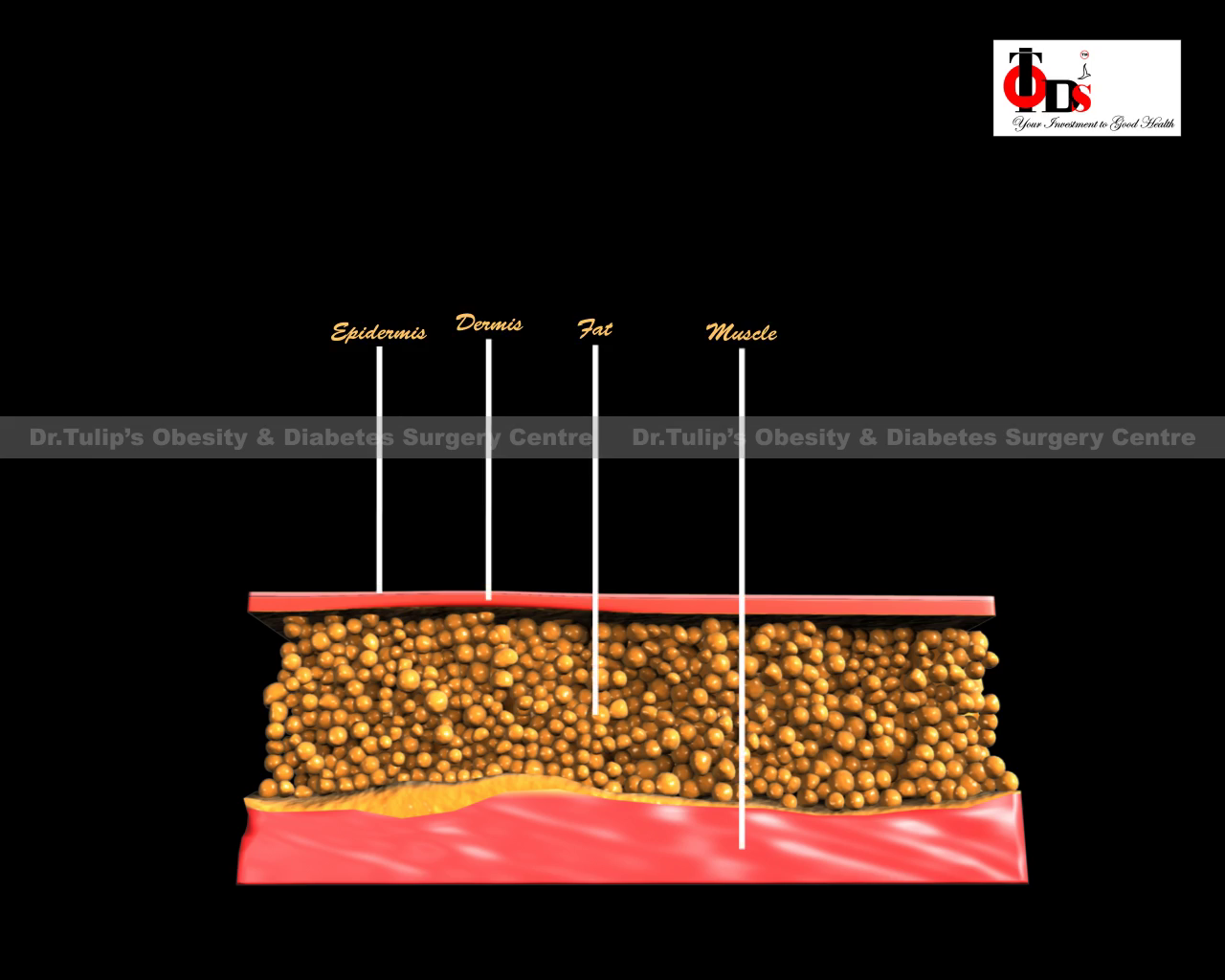  Haital Hernia surgery