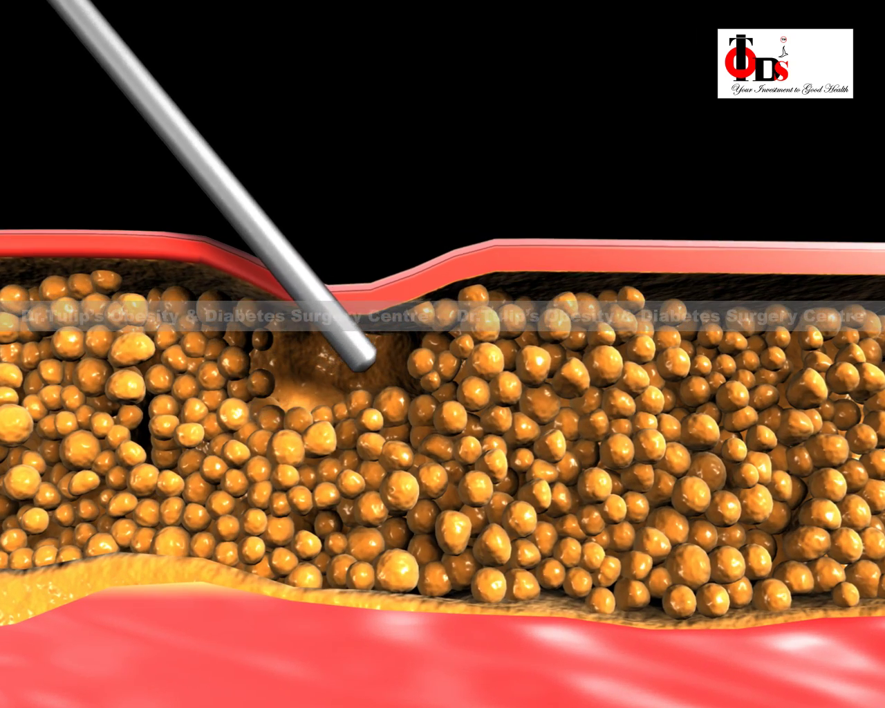  Haital Hernia surgery