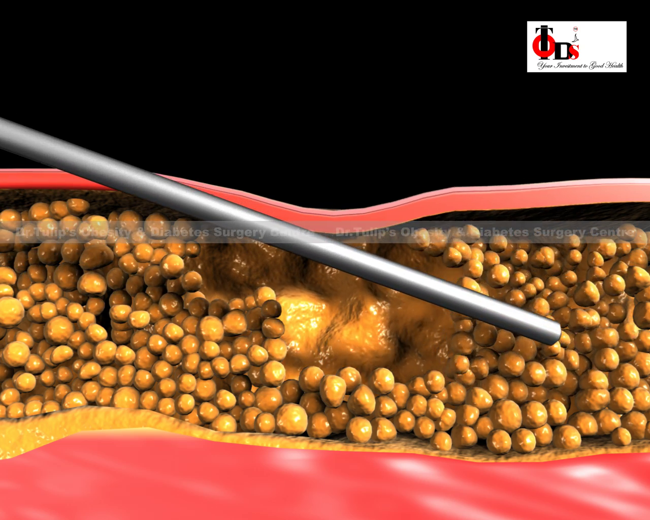  Haital Hernia surgery