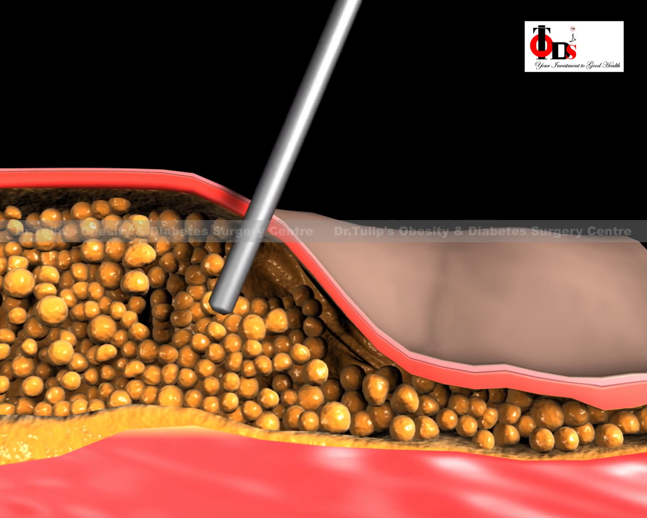  Haital Hernia surgery