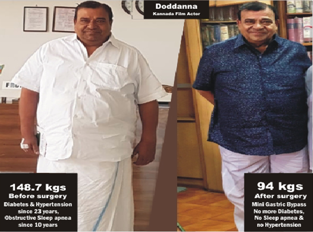 Doddanna is an indian actor from south india sandalwood industry he has went through metabolic surgery in dr tulip Dr-Tulip-Obesity-India-Koramangla-Bariatric-Surgery and found his transformation from 160kgs to 120 Kgs
