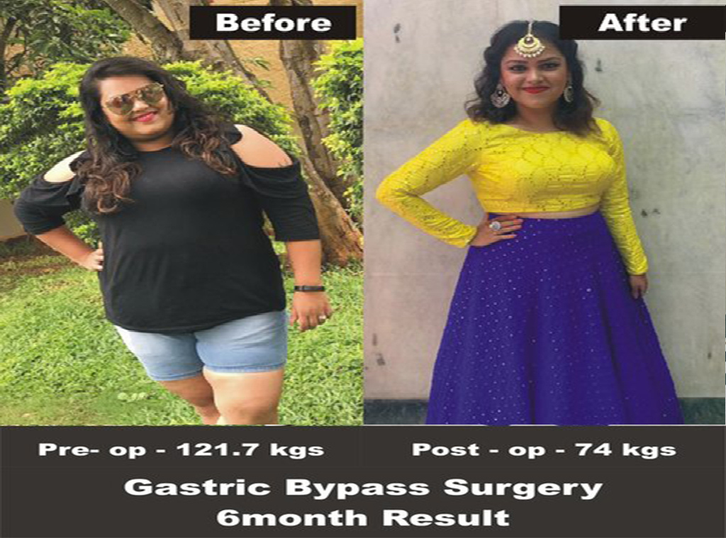 Megana got transformed for 100kgs to 60kgs after bariatric surgery