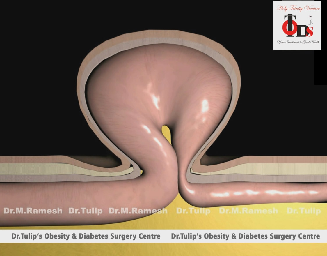  Haital Hernia surgery