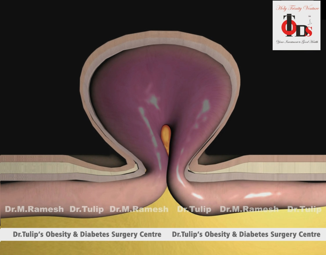  Haital Hernia surgery