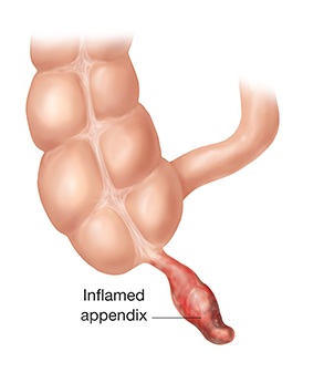 What is appendicitis? 