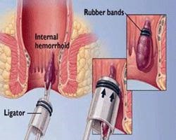  piles hemorrhoids 7