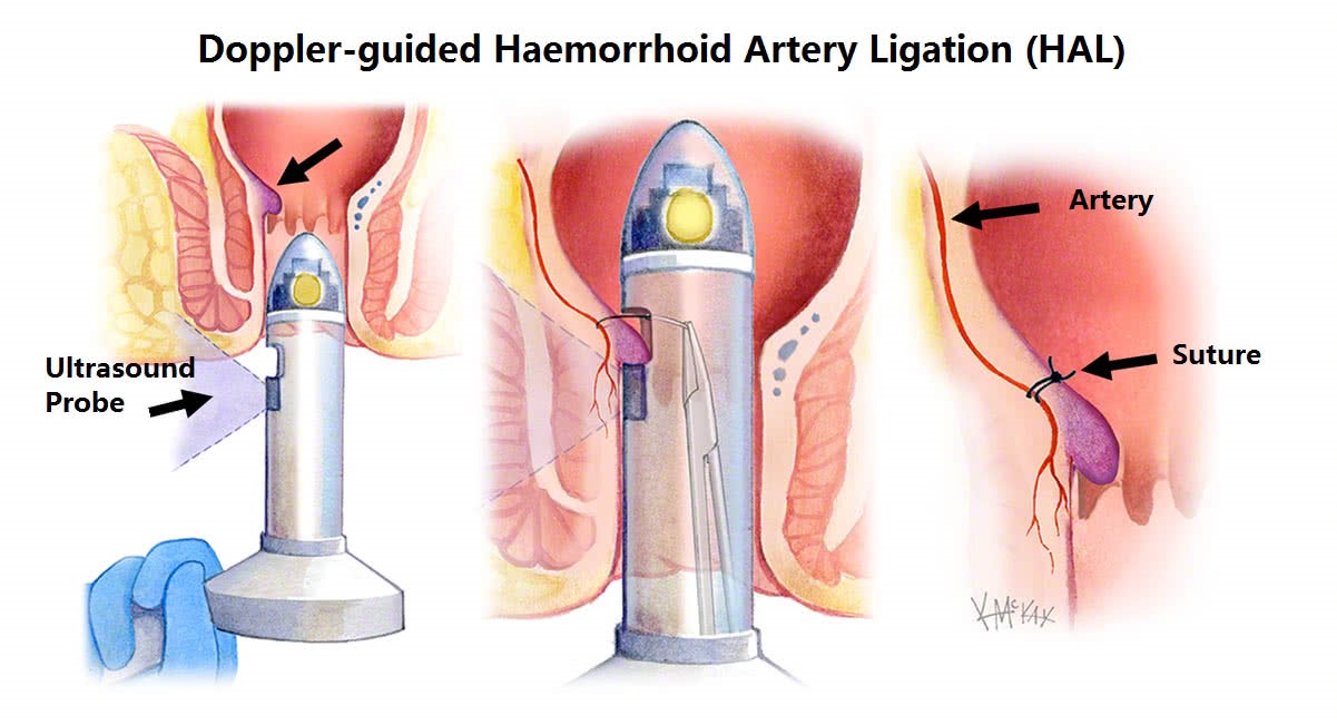  Opiles hemorrhoids 645