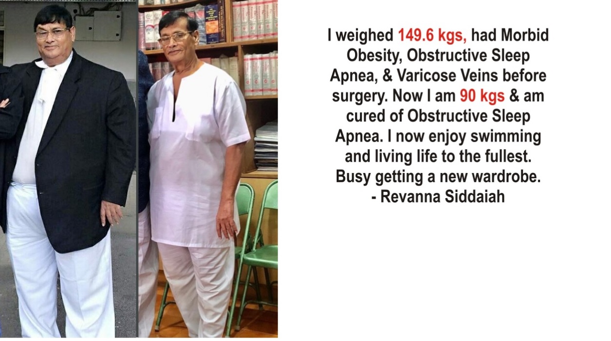 weight loss transformation after Weight Loss Surgery(Bariatric Surgery) in Bangalore