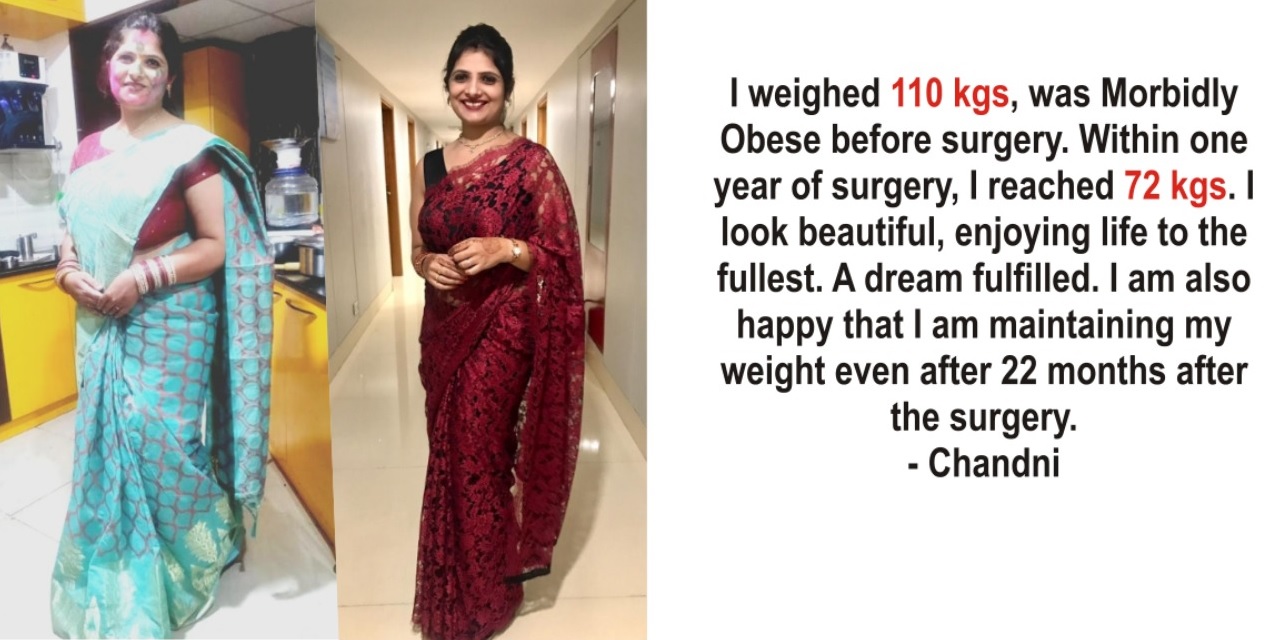 weight loss transformation after Weight Loss Surgery(Bariatric Surgery) in Bangalore